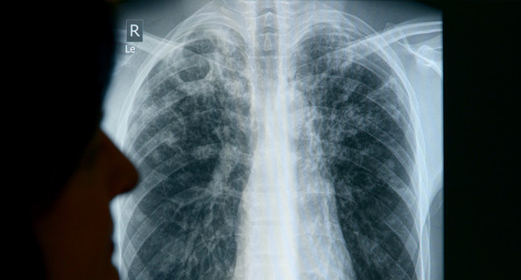 Röntgenaufnahme eines an Tuberkulose erkrankten Patienten (Bild: © Rainer Jensen/dpa)